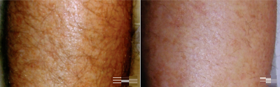 Laser Hair Removal before and after photo