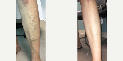 Sclerotherapy before and after photo