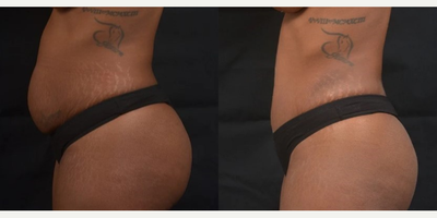 Tummy Tuck before and after photo