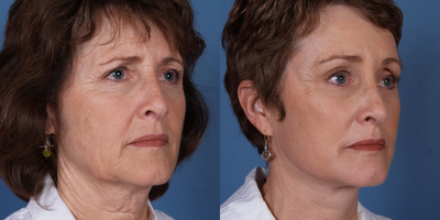 Deep Plane Facelift before and after photo