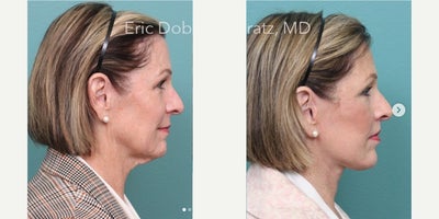 Deep Plane Facelift before and after photo