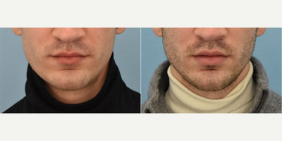 Lip Fillers before and after photo