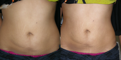 Thermage before and after photo