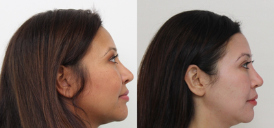 Buccal Fat Removal before and after photo