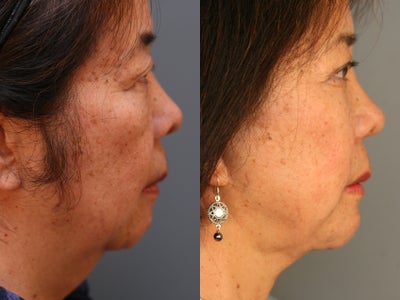 Chin Implant before and after photo
