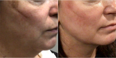 Cosmelan before and after photo