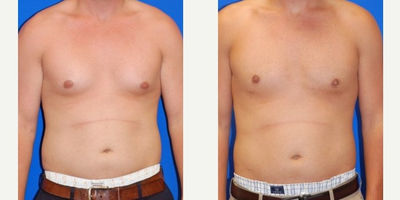 Liposuction before and after photo