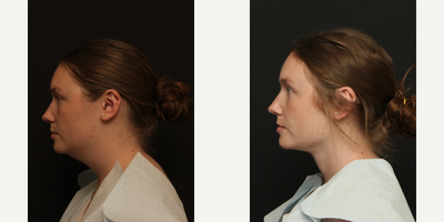 Neck Lift before and after photo