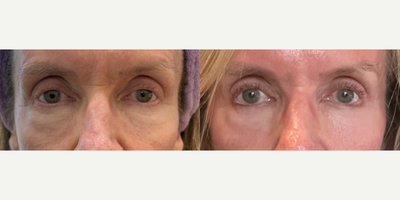 Nonsurgical Facelift before and after photo