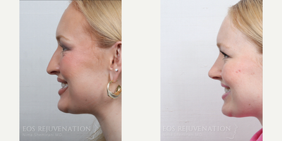 Rhinoplasty before and after photo