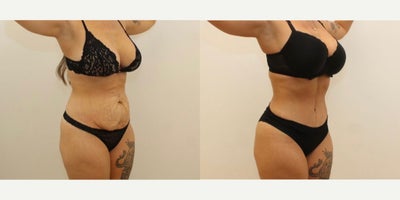 Tummy Tuck before and after photo
