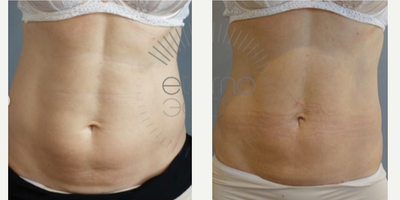 CoolSculpting before and after photo