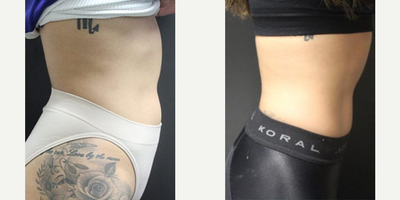Emsculpt before and after photo