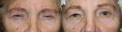 Eyebrow Transplant before and after photo