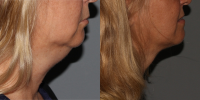 Kybella before and after photo