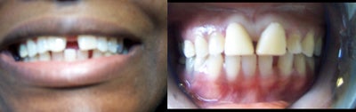 Porcelain Veneers before and after photo