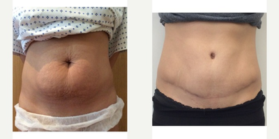 Tummy Tuck before and after photo