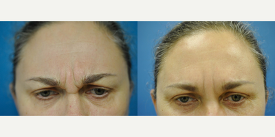 Botox before and after photo
