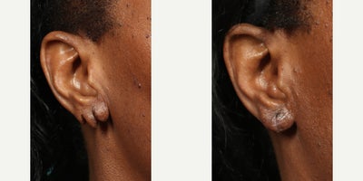 Ear Surgery before and after photo