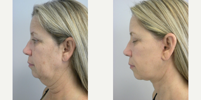 Facelift before and after photo