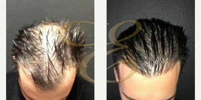 Hair Transplant before and after photo