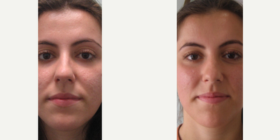 Morpheus8 before and after photo