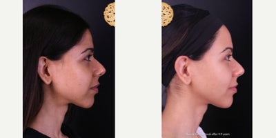 Buccal Fat Removal before and after photo