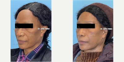 Dermal Fillers before and after photo