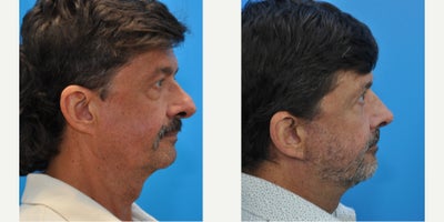 Facelift before and after photo