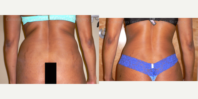 Liposuction before and after photo