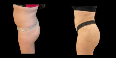 Renuvion before and after photo