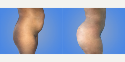 Breast Augmentation before and after photo