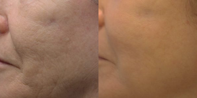 CO2 Laser before and after photo