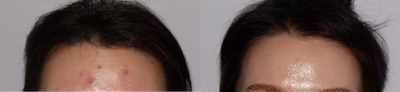 Microneedling before and after photo