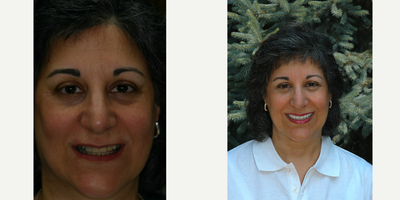 Dental Implants before and after photo