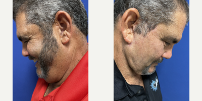 Facelift before and after photo