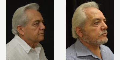 Facelift before and after photo