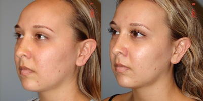 Forehead Reduction before and after photo