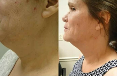 Fraxel Laser before and after photo