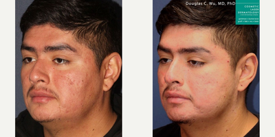 Vbeam before and after photo