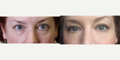 Dermal Fillers before and after photo