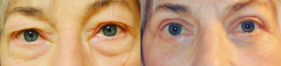 Eyelid Surgery before and after photo
