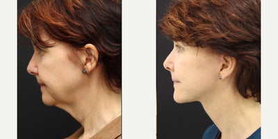 Facelift before and after photo