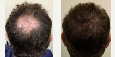 Hair Transplant before and after photo