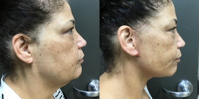 Lower Facelift before and after photo
