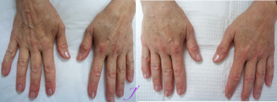 Radiesse before and after photo