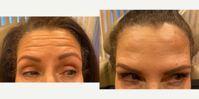 Botox before and after photo