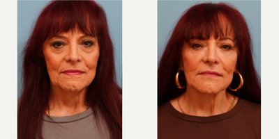 Dermal Fillers before and after photo