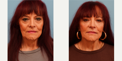Dermal Fillers before and after photo