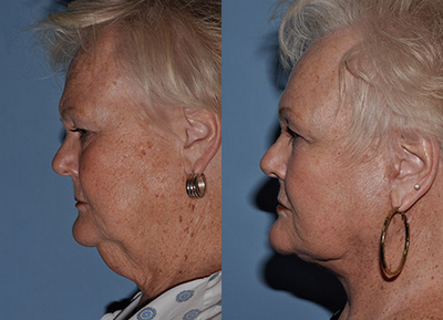 Facelift before and after photo